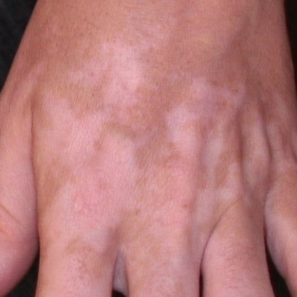Kombinasjon av karboksyterapi med smalbånd-ultrafiolett B i behandling av gjenstridige områder av vitiligo: En randomisert klinisk studie