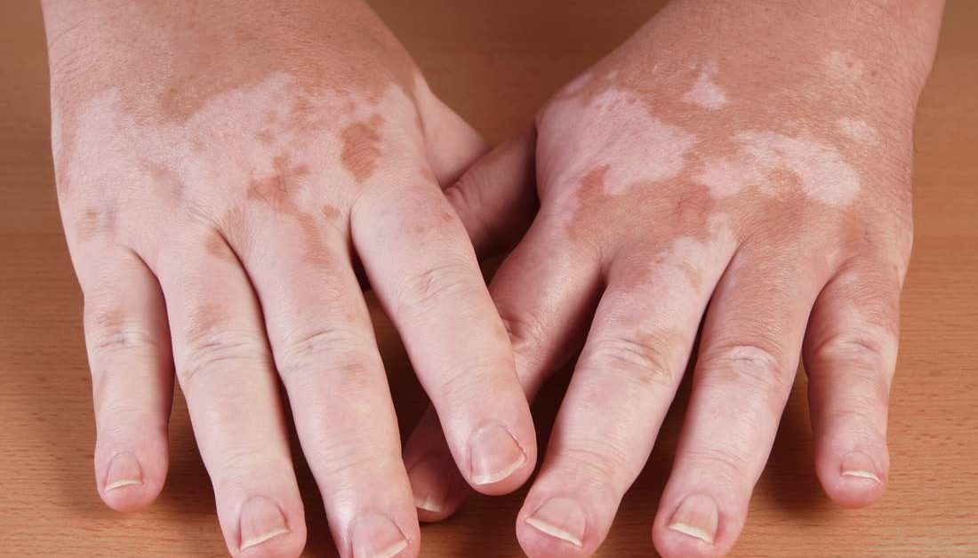 Funnene fra denne systematiske oversikten og metaanalysen tyder på at UV-fototerapi er en trygg behandling for vitiligo uten signifikant risiko for hudkreft.